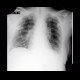 Pulmonary edema, after treatment: X-ray - Plain radiograph
